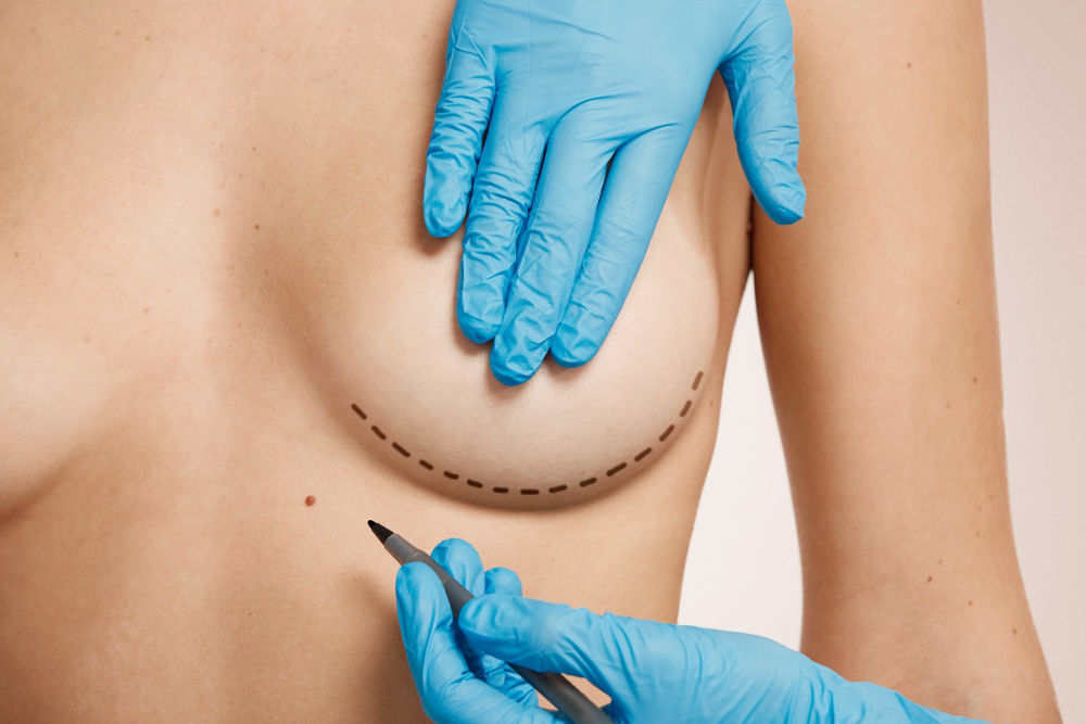 Breast Augmentation with Implants